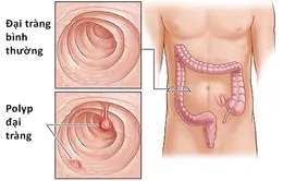 Phương pháp điều trị bệnh polyp đại tràng