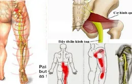 Các biện pháp chữa đau lưng, đau thần kinh tọa do thoát vị đĩa đệm