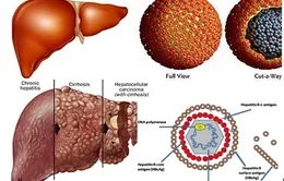 Viêm gan C - Căn bệnh thầm lặng để lại hậu quả nặng nề