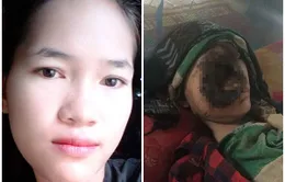 Chỉ vì đi khám răng, cô gái tội nghiệp vĩnh viễn mất đi khuôn mặt xinh đẹp