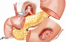 Bị ung thư, đừng đụng dao kéo?!