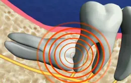Răng khôn - khôn hay dại?