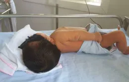 Trẻ sơ sinh vàng da phải thay máu hoàn toàn