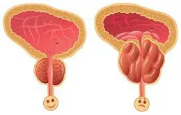 Nam giới nào dễ mắc ung thư tiền liệt tuyến?