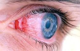 Những triệu chứng cảnh báo nguy cơ bệnh về mắt nguy hiểm