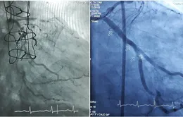 Đặt cùng lúc 3 stent cứu sống người phụ nữ khỏi tử thần