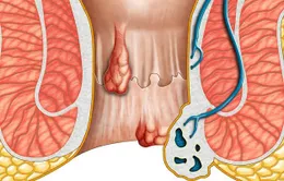 Độ tuổi nào dễ mắc ung thư hậu môn?