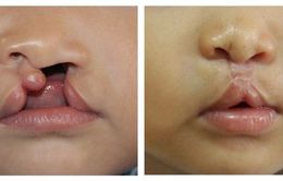 Phẫu thuật miễn phí dị tật khe hở môi, vòm miệng cho trẻ em ở Lạng Sơn