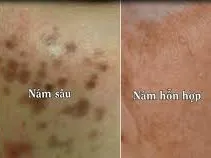 Vì sao nám thường phát triển mạnh vào mùa đông?