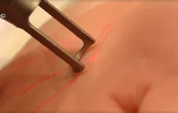 Phẫu thuật thay đổi chỉ tay để… đổi đời