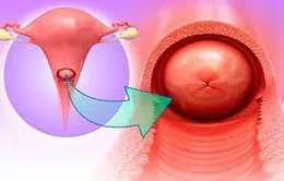 Chị em lưu ý dấu hiệu của viêm cổ tử cung