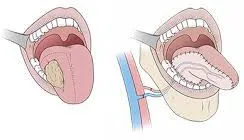 Dấu hiệu ung thư lưỡi mà bạn dễ dàng bỏ qua