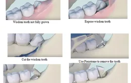 Infographics: Những điều bạn nên biết về răng khôn