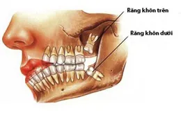 Răng khôn: Nỗi ám ảnh không của riêng ai