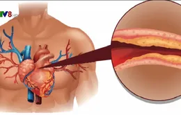 Phát hiện mới: Lượng cholesterol tốt quá cao dễ gây đau tim