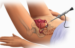 Phẫu thuật sa sinh dục bằng phương pháp cố định tử cung