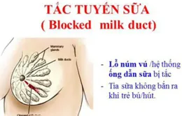 Tắc tia sữa - Nỗi ám ảnh của các bà mẹ sau sinh