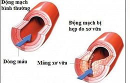 Xơ vữa động mạch chân có nguy hiểm?