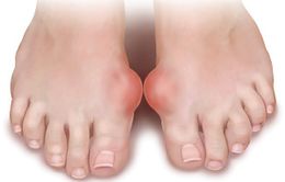 Từ A - Z những điều cần biết về bệnh Gout