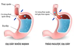 8 dấu hiệu cảnh báo bệnh viêm thực quản trào ngược