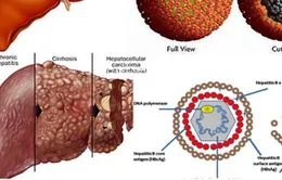 Gần 70% ca ung thư gan có nhiễm virus viêm gan B