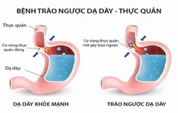 Viêm họng do trào ngược dạ dày thực quản, bạn đã biết?