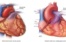 Hội chứng nguy hiểm Marfan – mối đe dọa cho tim và máu