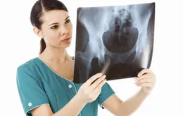 Mức độ lo lắng và việc gãy xương ở phụ nữ