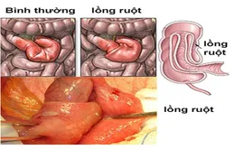 Bệnh lồng ruột cấp ở trẻ em: Cần can thiệp sớm trong vòng 24 giờ