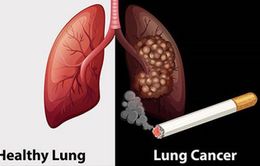 Ai nên tầm soát ung thư phổi?