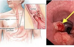 Yếu tố nào có nguy cơ gây ung thư thực quản?