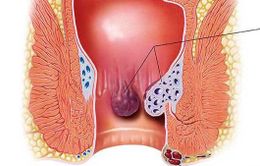 Điều trị trĩ không đúng cách, bệnh nhân phải truyền 13 đơn vị máu