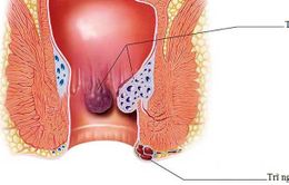 Bệnh trĩ không xấu - Tại sao phải giấu?