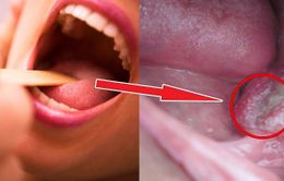 Dấu hiệu dễ bỏ qua của ung thư vòm họng