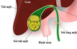 10 - 25% dân số mắc bệnh lý sỏi đường mật