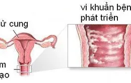 Hương thơm gỗ đàn hương có thể giải quyết các khối u ung thư bàng quang