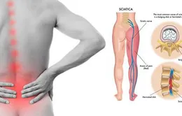 Nguyên nhân nào gây đau thần kinh tọa?