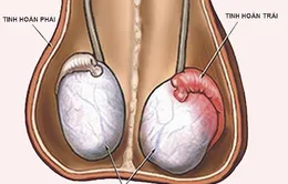 Viêm tuyến tiền liệt ở nam giới có thể gây vô sinh