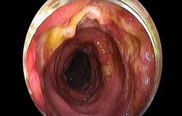 Nữ bệnh nhân bị nhiễm trùng máu do viêm ruột nặng