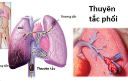 Thuyên tắc phổi - Bệnh do nằm bất động quá lâu có thể gây tử vong