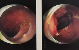 Mới 29 tuổi, người đàn ông bị polyp chằng chịt trong đại tràng