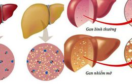 Top 4 nguyên nhân gây gan nhiễm mỡ và cách phòng tránh