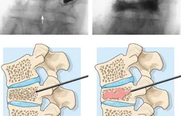 Phẫu thuật cột sống không phải là phương pháp hữu hiệu để giảm đau lưng do loãng xương
