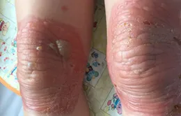 Bỏng đầu gối do bó thuốc nam trị đau khớp