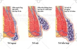 Triệu chứng và cách phòng, điều trị bệnh trĩ