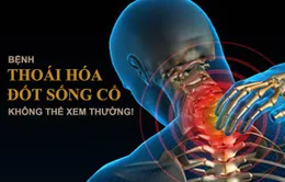 Nguy cơ bại liệt từ bệnh lý thoái hóa đốt sống cổ