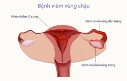 Bùng nổ căn bệnh lây lan qua đường tình dục khiến phụ nữ vô sinh