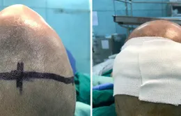 Giải cứu bệnh nhi khỏi hộp sọ hình tam giác