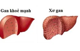 Biểu hiện thầm lặng ít biết của bệnh xơ gan