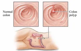 Polyp trực tràng và những điều cần biết